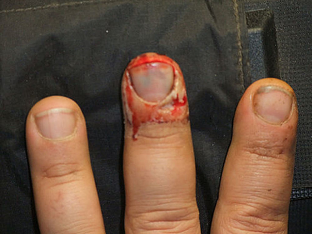 Close up of André Barmasse’s splattered middle finger (view not suited for weak people) (photo: S. G. Schmid)